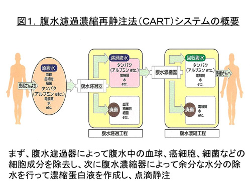 KM CART 腹水濾過濃縮再静注法